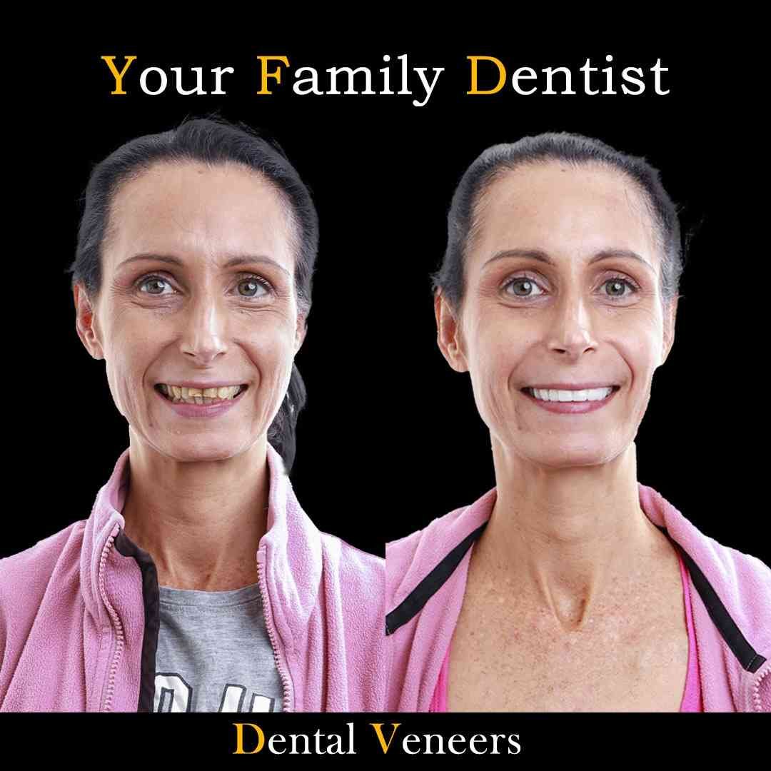 Dental Veneers