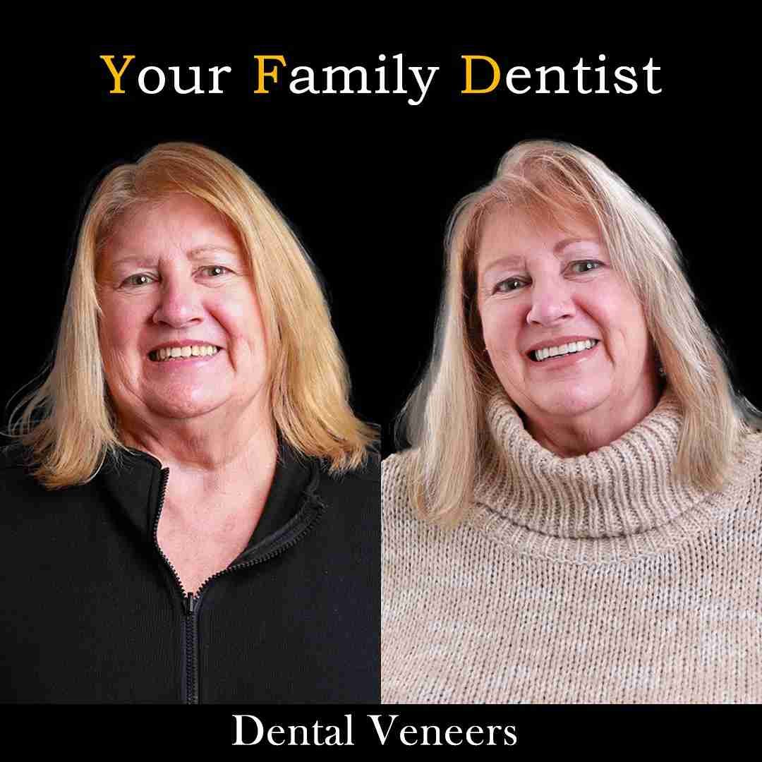 Dental Veneers