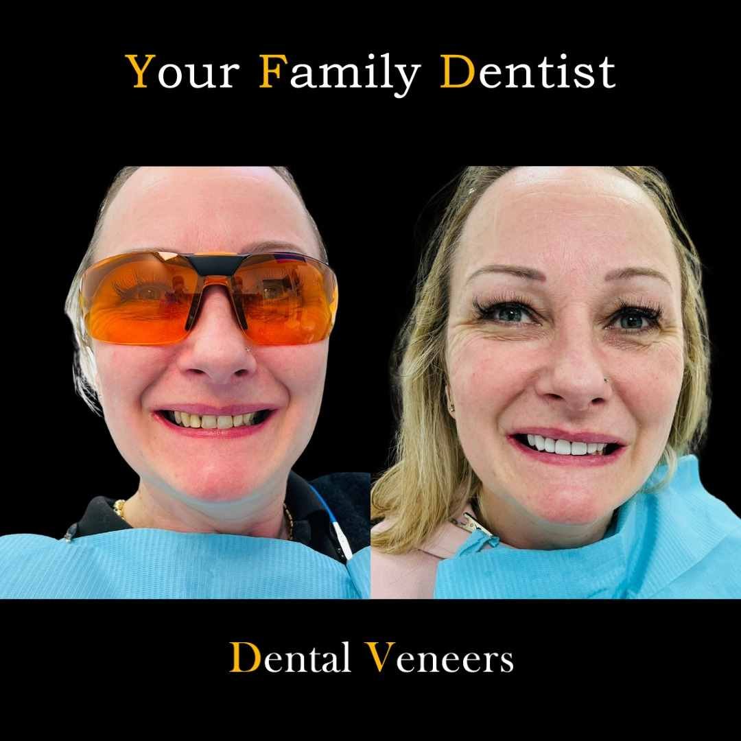 Dental Veneers