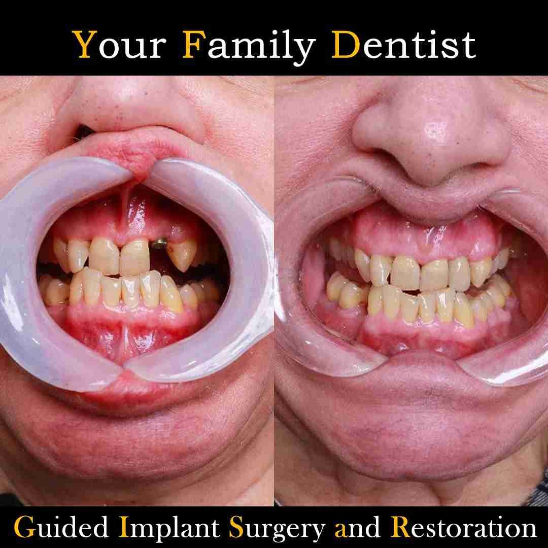 guided implant surgery and restoration