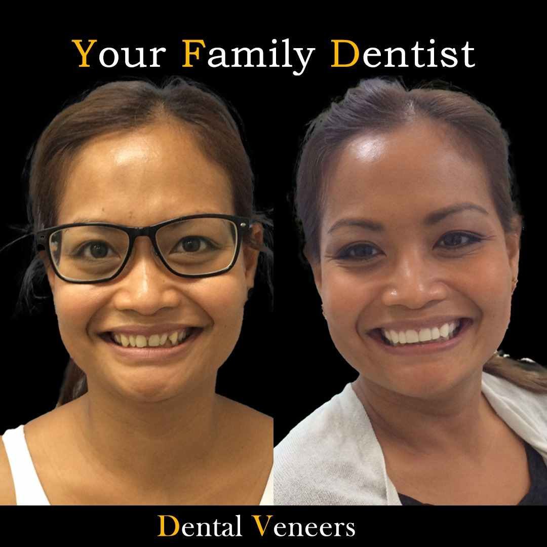 veneers