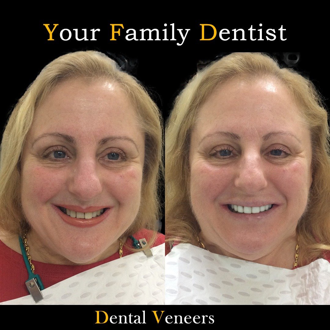veneers