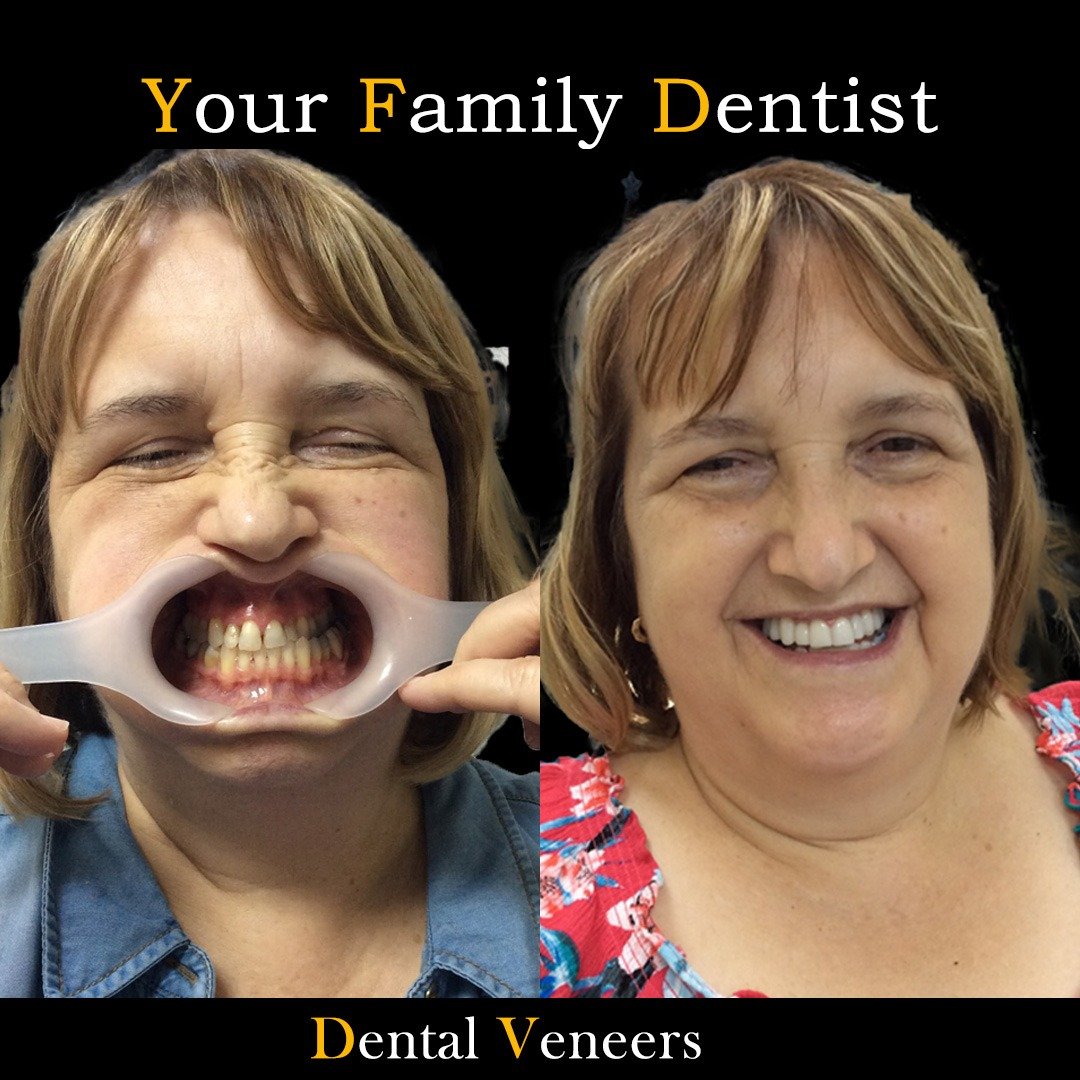 Dental Veneers