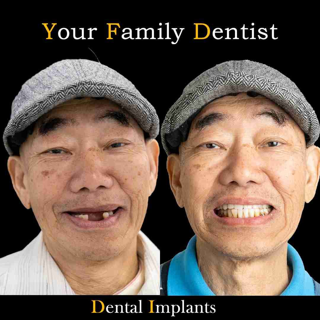 Dental implants