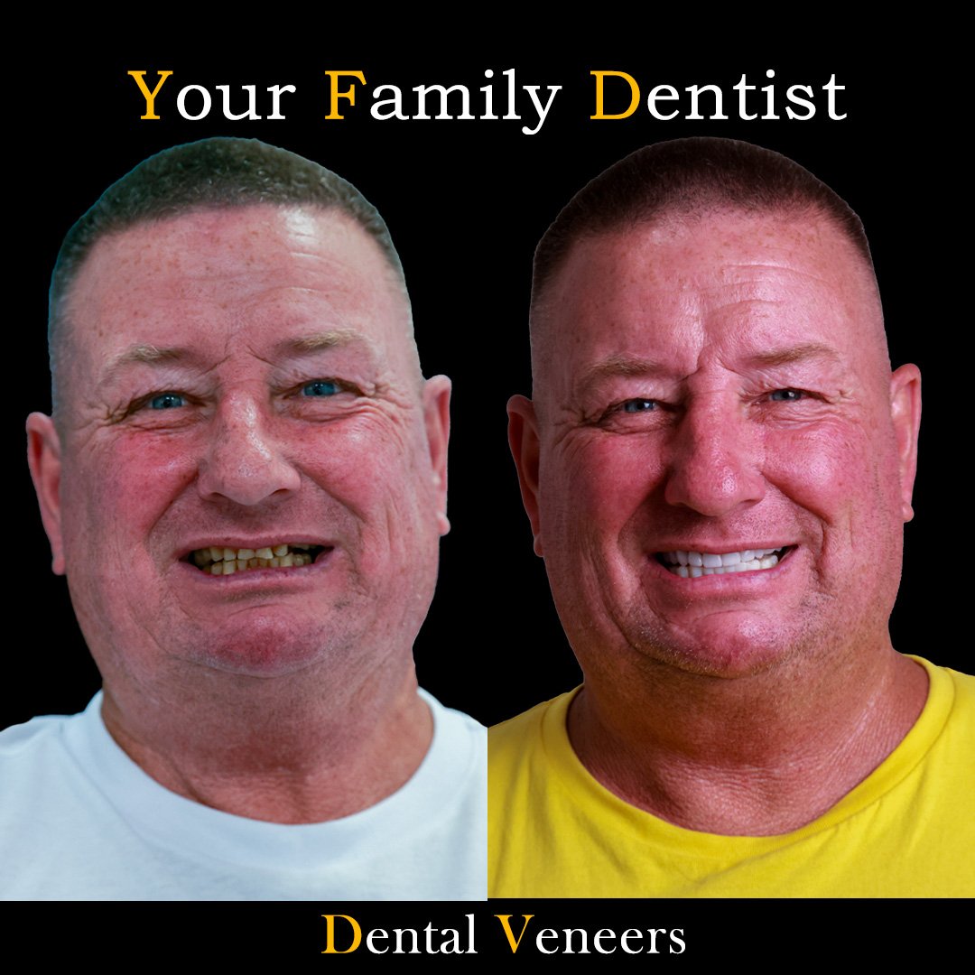 veneers