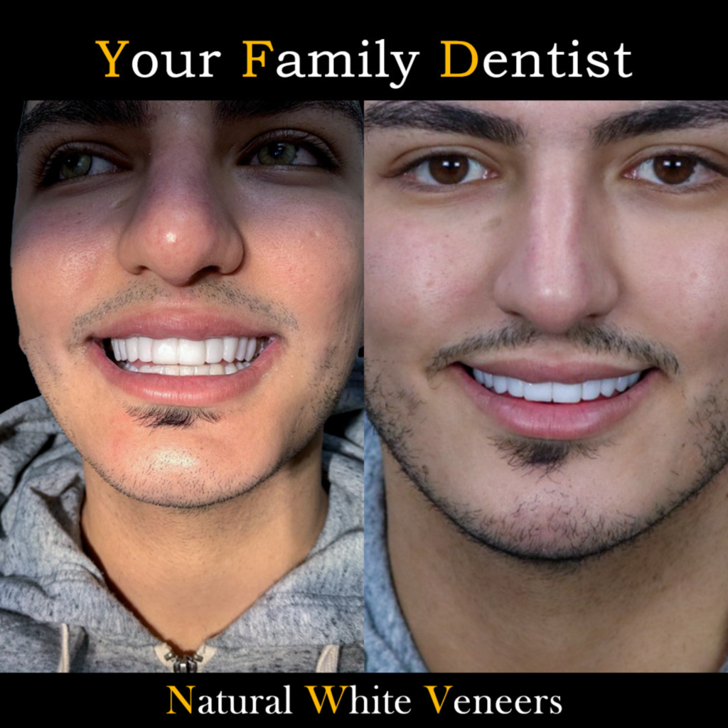 Dental Veneers