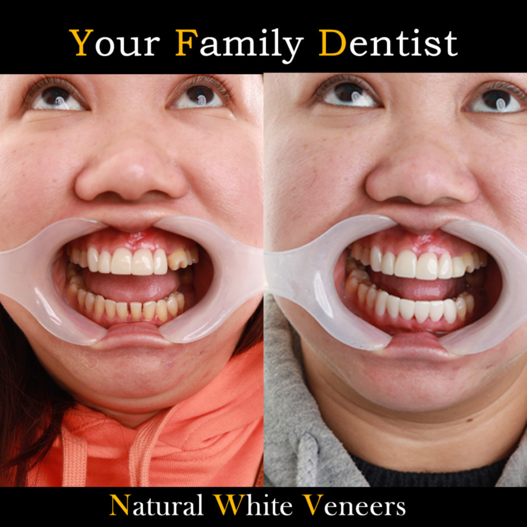 Dental Veneers