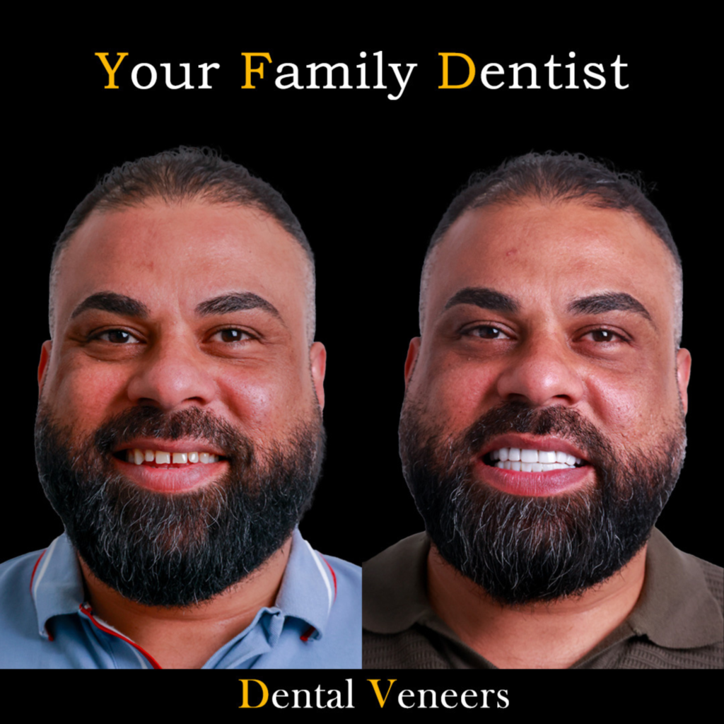 Dental Veneers