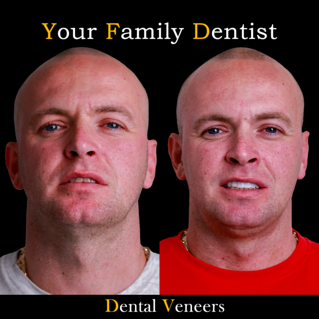Dental Veneers
