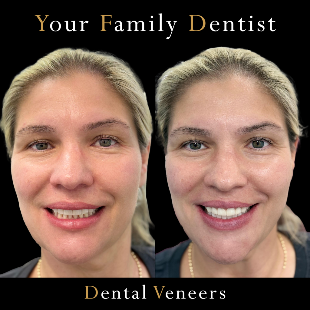 Dental Veneers