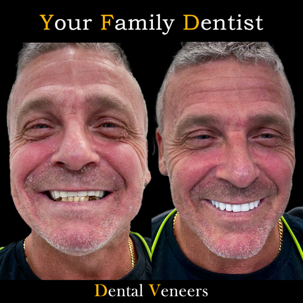 Dental Veneers