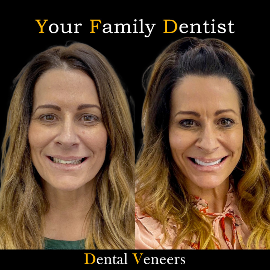 Dental Veneers