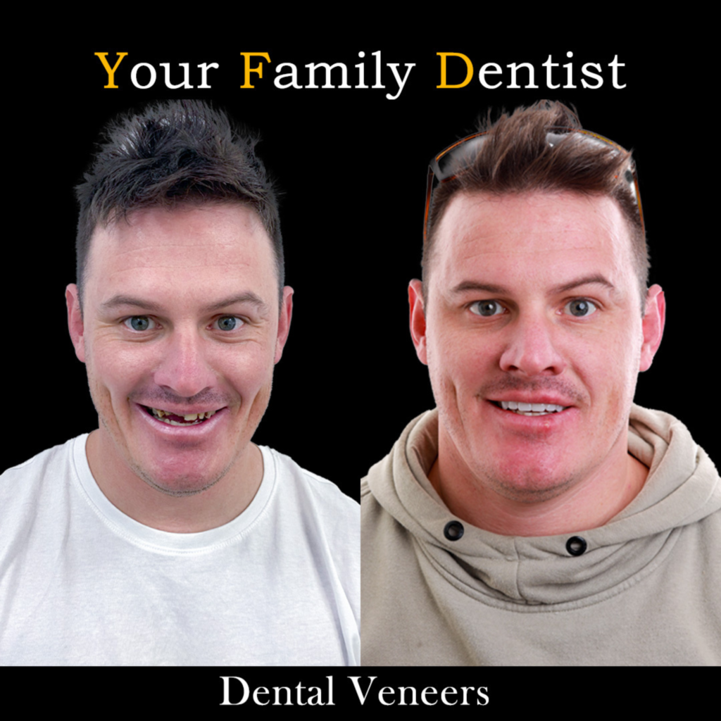 Dental Veneers