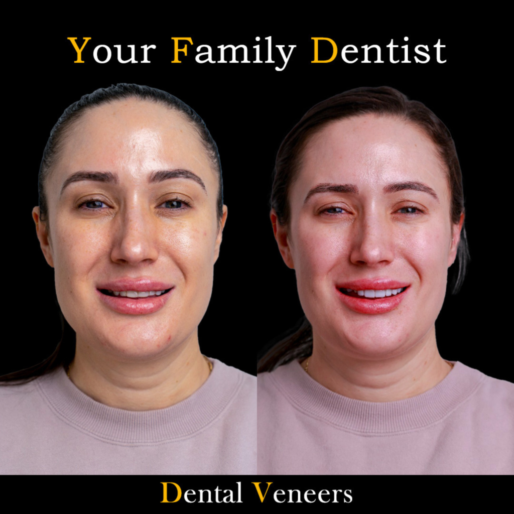 Dental Veneers