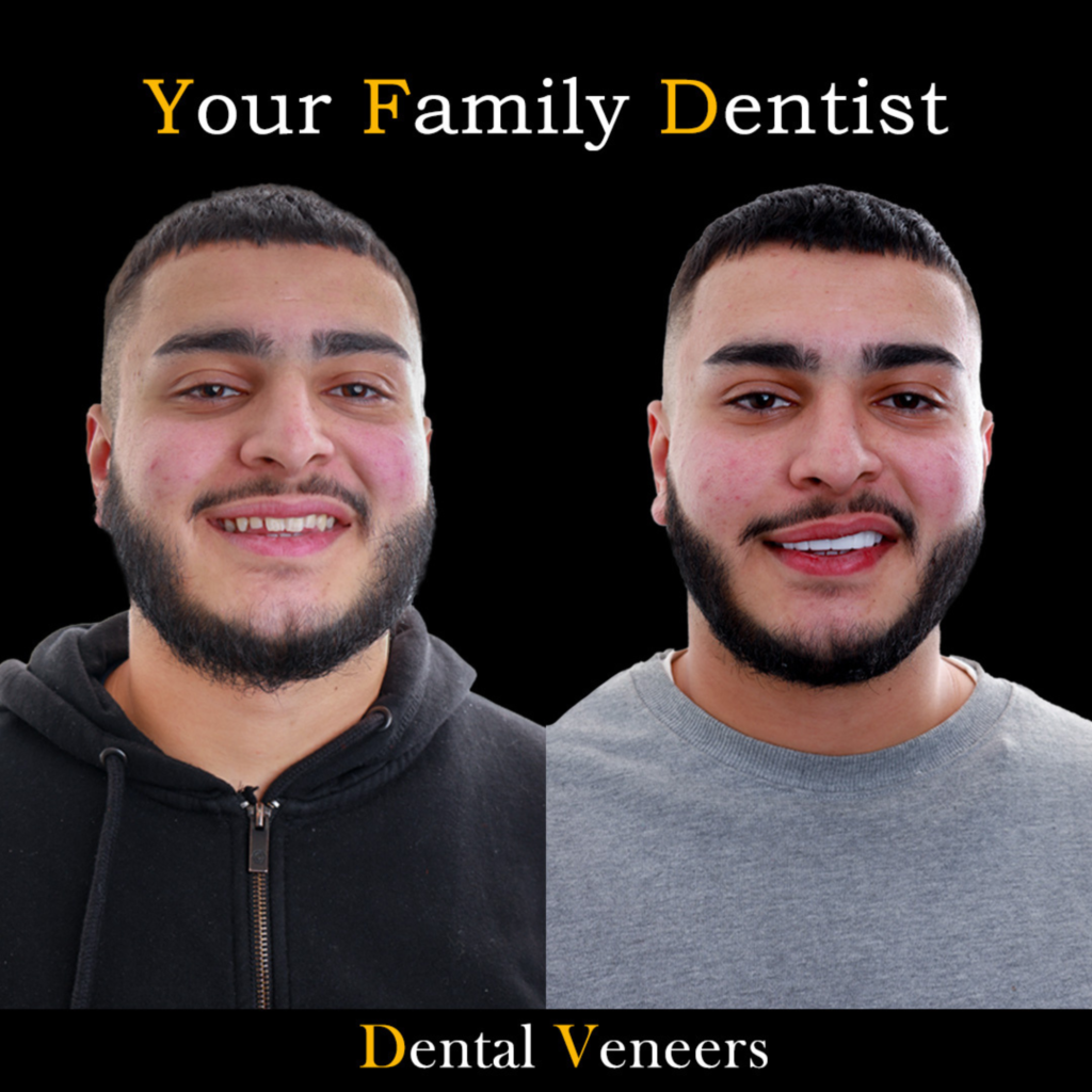Dental Veneers