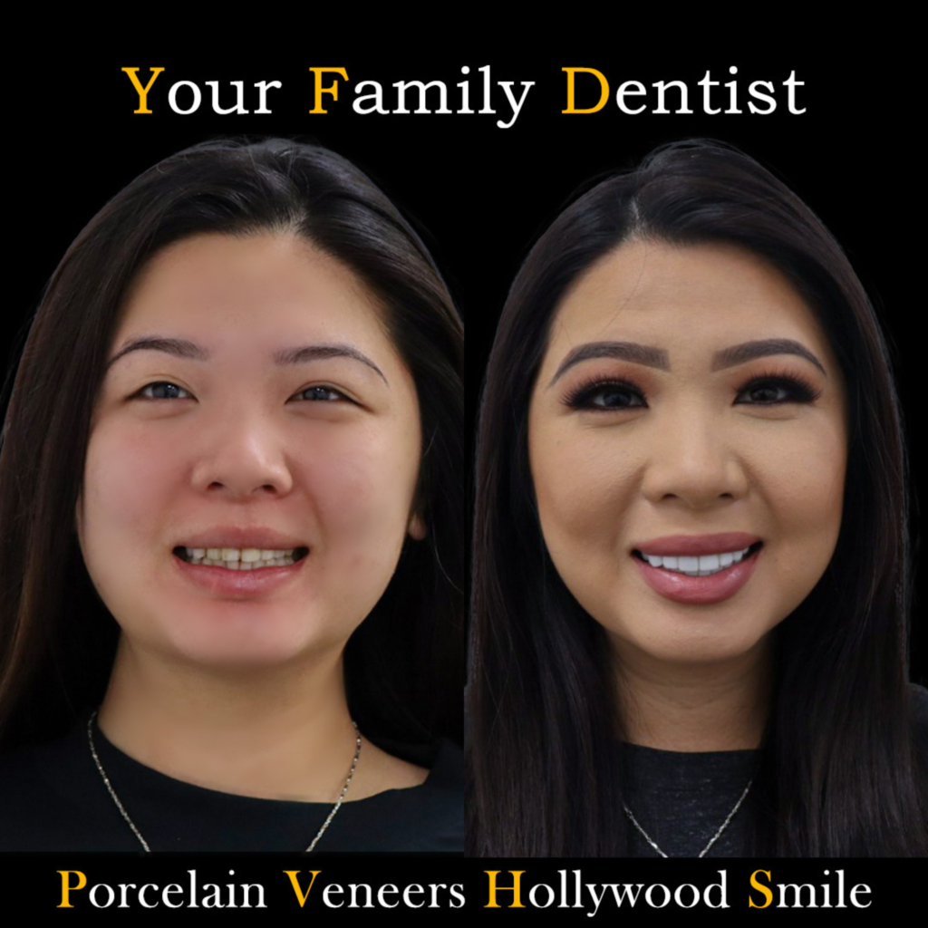 Dental Veneers