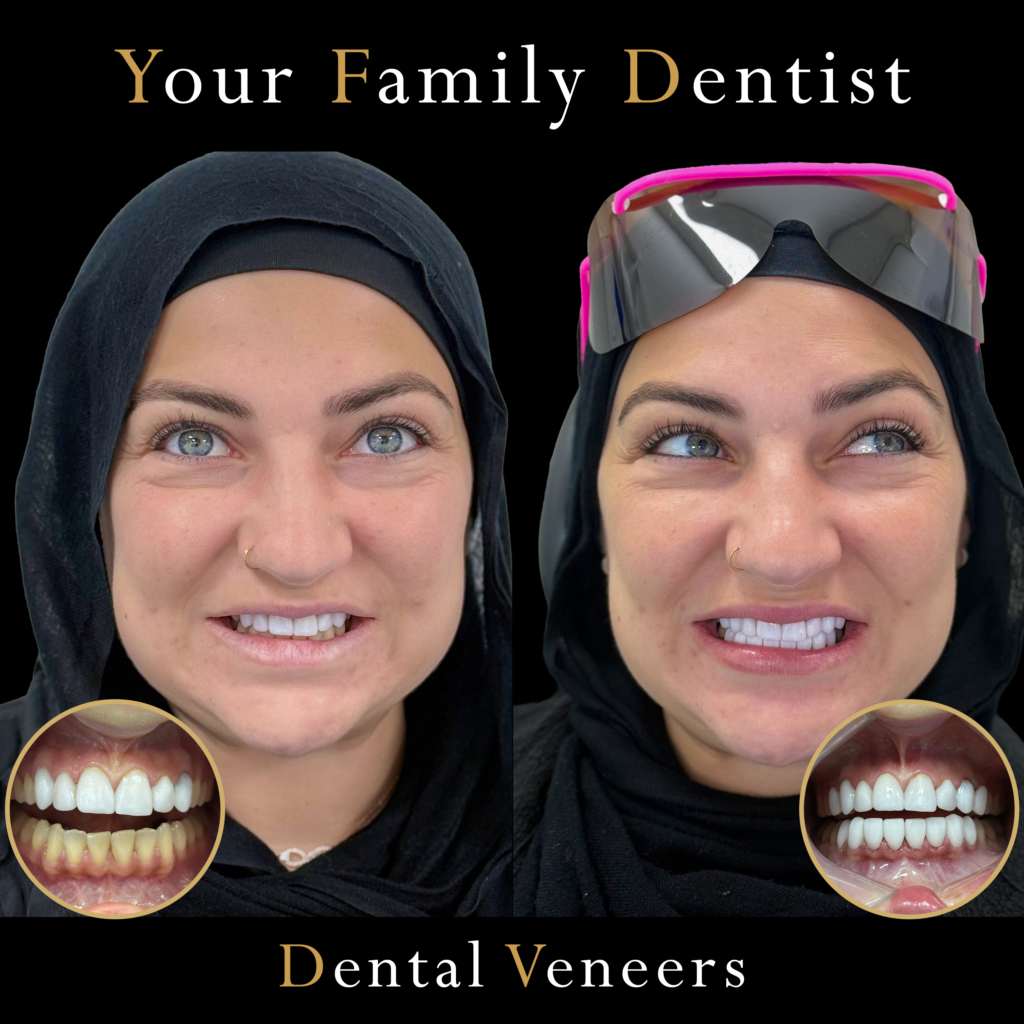 Dental Veneers