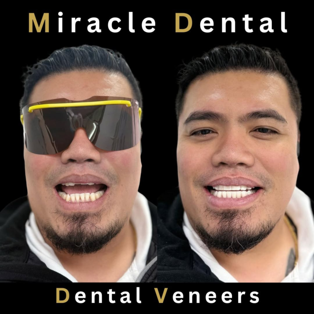 Dental Veneers