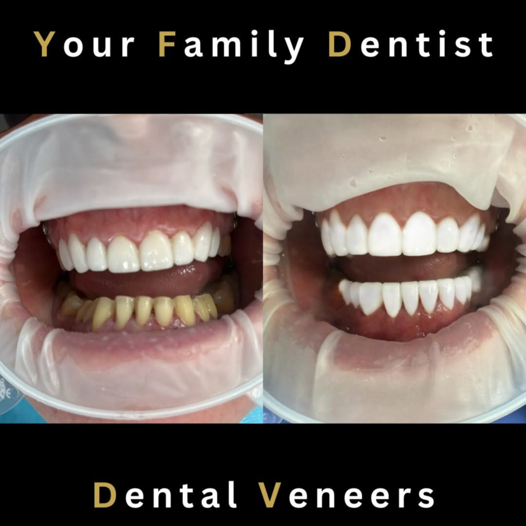 Dental Veneers