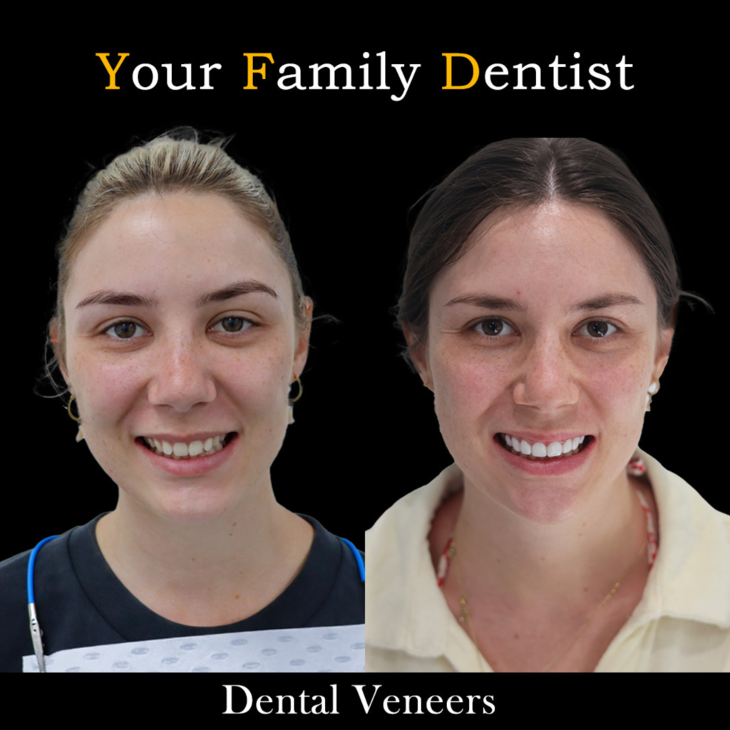 Dental Veneers