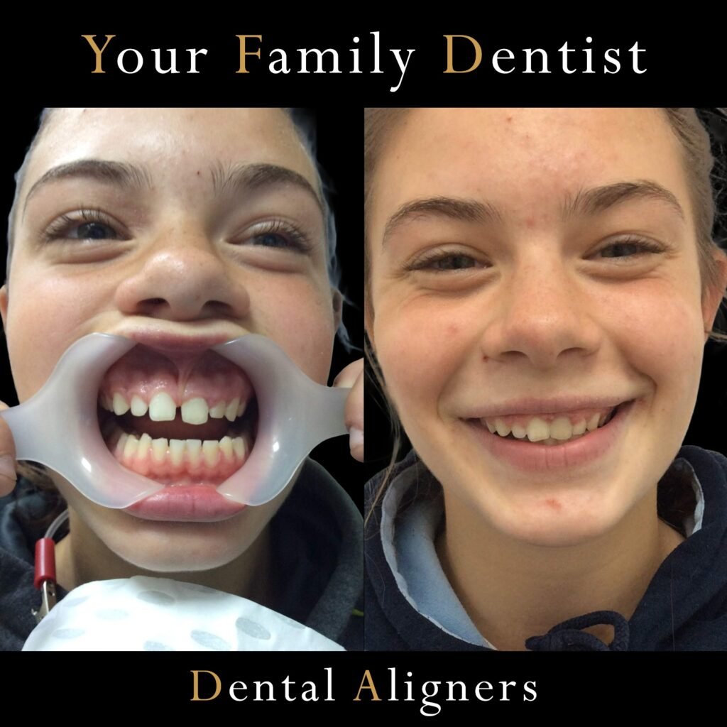 Aligners