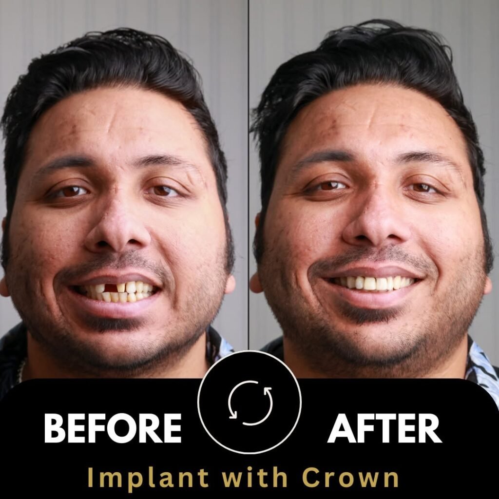 Before and After Implant Crown 64