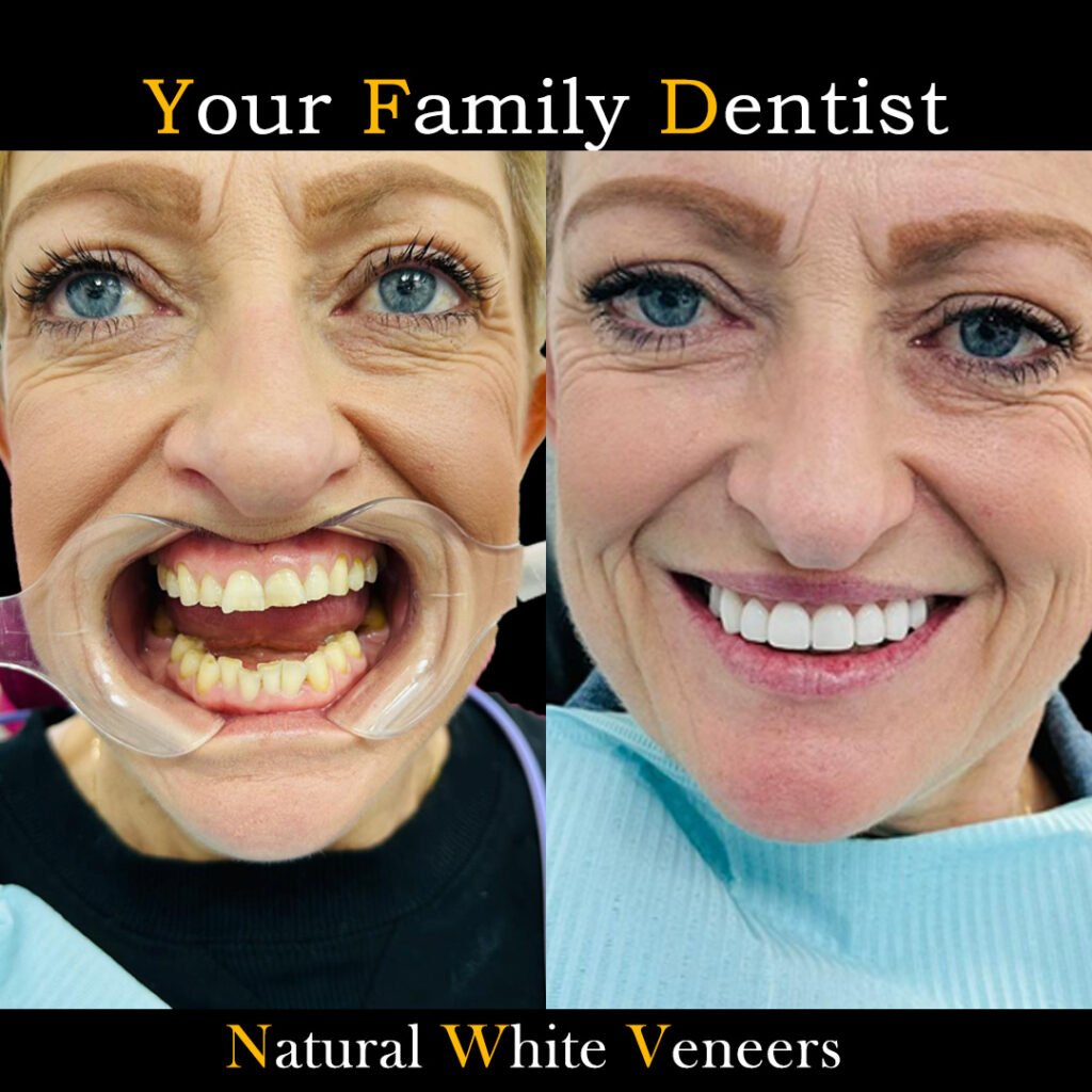 Before and After Natural White Veneers 3