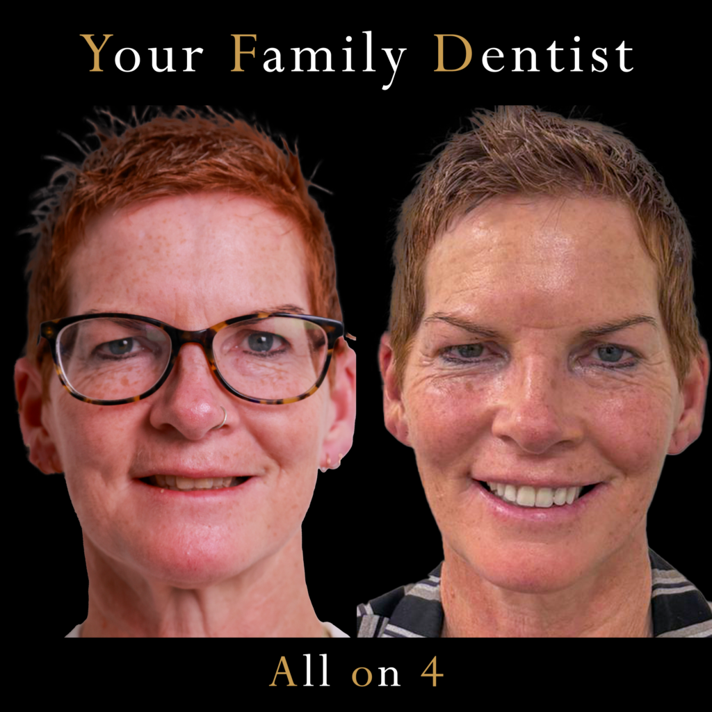 All ON 4 Dental Impant