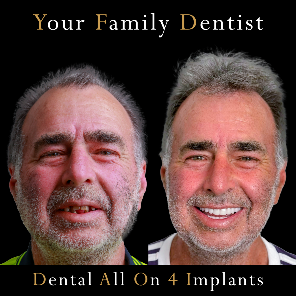 All ON 4 Dental Impant