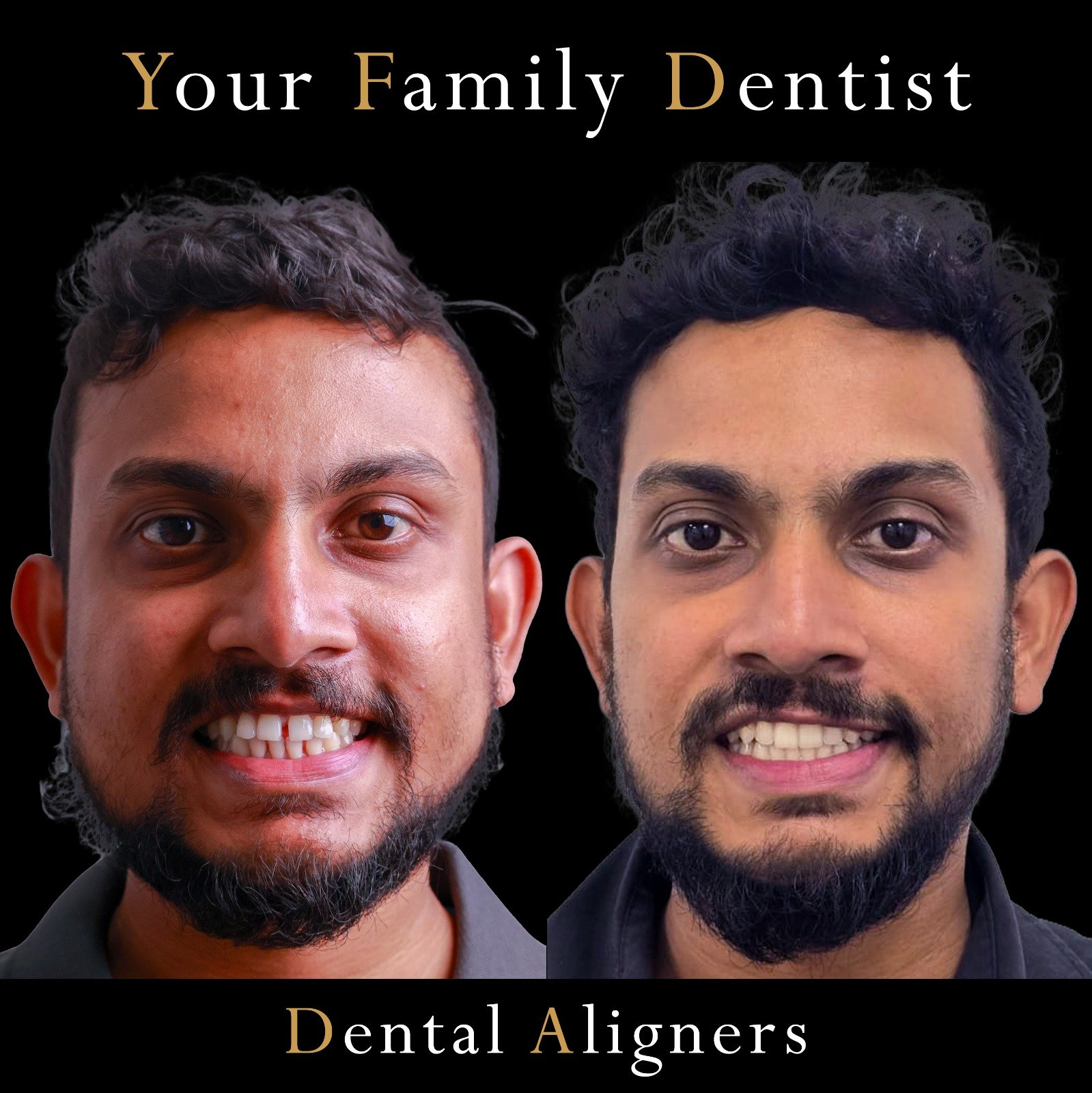 Aligners